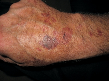   -Red cell morphology such as the one at the tip of the pointer are associated with: A)  von Willebrand's disease B)  Glanzmann's thrombasthenia C)  Thrombotic thrombocytopenic purpura D)  All of the above