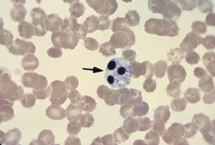   -The cell at the tip of the pointer is: A)  A basophil B)  A malignant cell C)  A degenerating neutrophil D)  Not a cell; it's an artifact