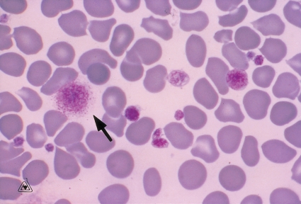   -The cell at the tip of the pointer is a: A)  Hairy cell B)  Basket cell C)  Degenerating lymphocyte D)  Giant platelet
