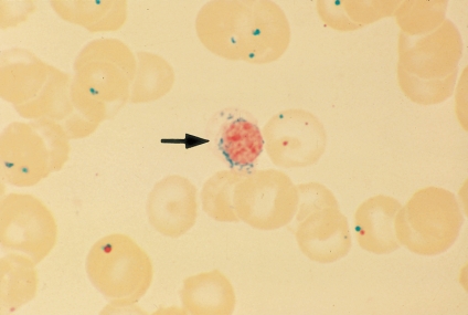   -The correct name for the cell at the end of the pointer is a: A)  Ringed sideroblast B)  Reticulocyte C)  Giant platelet D)  Siderocyte