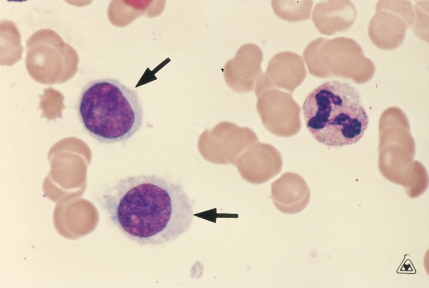   -The cells at the tip of the pointer are most frequently associated with: A)  CLL B)  Hairy cell leukemia C)  Sézary syndrome D)  Multiple myeloma