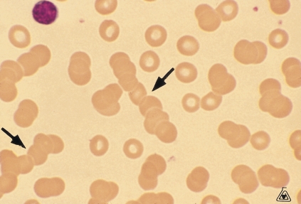   -The phenomenon pictured above is known as rouleaux and is frequently associated with: A)  An increased red cell count B)  A decreased MCV and MCHC C)  An elevated ESR D)  All of the above