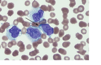   -The cells pictured above are most consistent for: A)  Acute myeloid leukemia B)  Acute myelomonocytic leukemia C)  Acute lymphoblastic leukemia D)  Acute erythroid leukemia