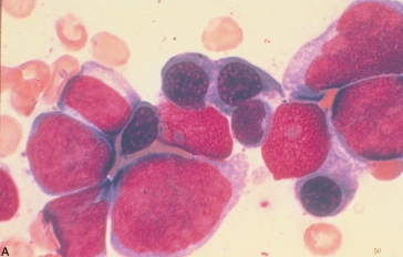   -The cells pictured above are most consistent with: A)  Acute myeloid leukemia B)  Acute myelomonocytic leukemia C)  Acute lymphoblastic leukemia D)  Acute erythroid leukemia