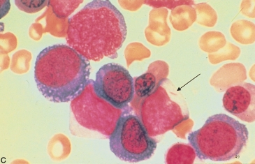   -The structure at the end of the pointer is a(n) : A)  Auer rod B)  Dohle body C)  Engulfed bacteria D)  None of the above