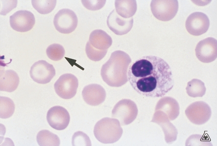  -Name the cell at the tip of the pointer (Wright stain) . A)  Spherocyte B)  Target cell C)  Platelet D)  Acanthocyte