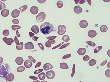   -The cell at the tip of the pointer would be described as a/an: A)  Acanthocyte B)  Elliptocyte C)  Sickle cell D)  Stomatocyte