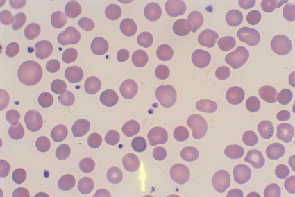   -The cell at the tip of the pointer is referred to as a: A)  Stomatocyte B)  Target cell C)  Normal erythrocyte D)  Spherocyte