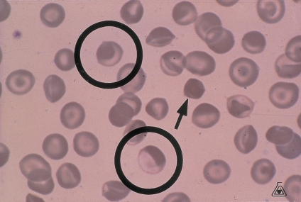   -The cells circled below show an eccentric  puddling  of their hemoglobin contents.This is most closely associated with: A)  Stomatocytosis B)  Xerocytosis C)  G6PD deficiency D)  Pyruvate kinase deficiency