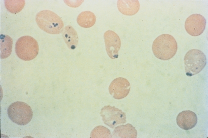   -The inclusions pictured below are seen with supravital staining only.These inclusions are most likely: A)  Heinz bodies B)  Howell-Jolly bodies C)  Pappenheimer bodies D)  Due to stain contamination