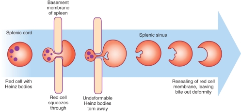   -The cell pictured at the tip of the pointer is known as a (an) : A)  Sickle cell B)  Acanthocyte C)  Bite cell D)  Stomatocyte