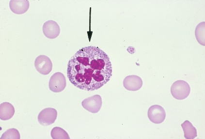   -The cell pictured above may be seen in which of the following conditions? A)  Iron deficiency anemia B)  Megaloblastic anemia C)  Thalassemia major D)  Hereditary hemochromatosis