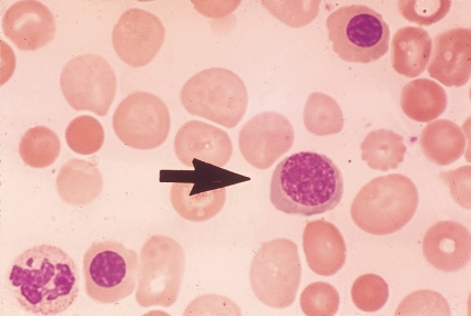   -The stage of development of the cell at the end of the pointer is: A)  Polychromatophilic normoblast B)  A reticulocyte C)  A rubricyte D)  An orthochromatic normoblast
