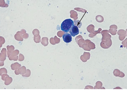   -Describe the hemoglobin content of the cell at the end of the pointer. A)  Normochromic B)  Hypochromic C)  Polychromatophilic D)  Hyperchromic