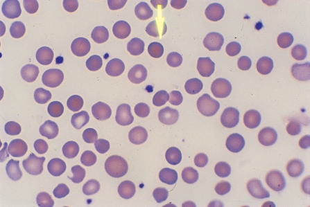   -Identify the cell at the end of the pointer. A)  Spherocyte B)  Schistocyte C)  Acanthocyte D)  Normocyte