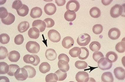  -Identify the cell at the end of the pointers. A)  Reticulocyte B)  Spherocyte C)  Sickle cell D)  Target cell
