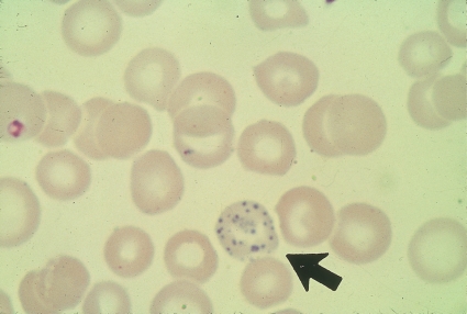   -The term used to describe the inclusions seen in the cell at the end of the pointer is (Wright's stain) : A)  Pappenheimer bodies B)  Basophilic stippling C)  Howell Jolly bodies D)  Siderotic granules