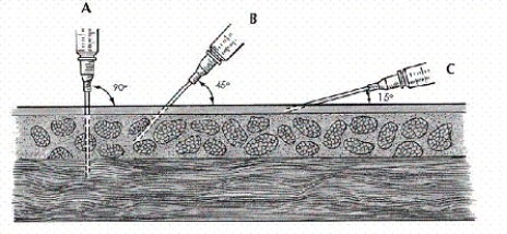 <strong>Using the illustration below,select the proper angle for the nurse to use in administering a subcutaneous injection for the average adult.  </strong> A)90° B)45° C)15° D)Any of the above <div style=padding-top: 35px> 