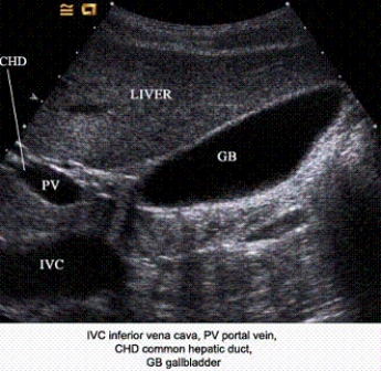 Describe the orientation of the major structures in this sagittal scanning plane image just to the right of the midline of the body.     a. ____________ section of the IVC b. ____________ section of the PV c. ____________ section of the CHD d. ____________ section of the GB e. ____________ section of the liver