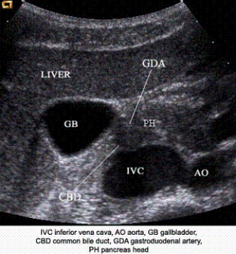 Describe the orientation of the major structures in this transverse scanning plane image just to the right of the midline of the body.     a. ________ section of the IVC b. ________ section of the AO c. ________ section of the GB d. ________ section of the CBD e. ________ section of the GDA f. ________ section of the PH  g. ________ section of the liver