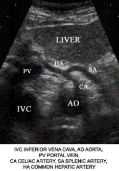 Describe the orientation of the major structures in this transverse scanning plane image of the upper epigastrium.     a. ________ section of the IVC b. ________ section of the AO c. ________ section of the CA d. ________ section of the SA e. ________ section of the HA f. ________ section of the liver