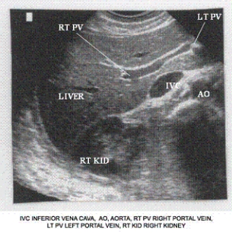 Describe the orientation of the major structures in this transverse scanning plane image of the right upper quadrant.     a. ________ section of the IVC b. ________ section of the AO c. ________ section of the RT KID d. ________ section of the RT PV e. ________ section of the LT PV f. ________ section of the LIVER