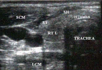 Describe the orientation of the major structures in this transverse scanning plane image just to the right of the midline of the neck.     a. ________ section of the RT L b. ________ section of the CCA c. ________ section of the JV d. ________ section of the LCM e. ________ section of the ST f. ________ section of the SH g. ________ section of the SCM h. ________ section of the TRACHEA i. ________ section of the ISTHMUS