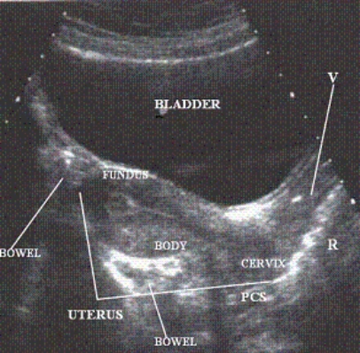 Describe the orientation of the major structures in this sagittal scanning plane image at the midline of the pelvis.     a. ________ section of the UTERUS b. ________ section of the VAGINA c. ________ section of the BLADDER