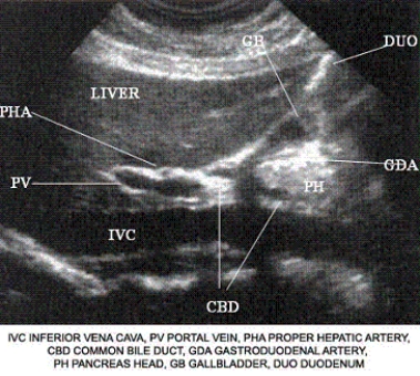 Using the image below, describe the anatomic relationship of the common hepatic duct to adjacent structures.   