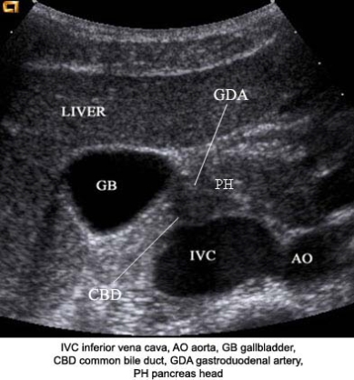 Using the image below, describe the anatomic relationship of the inferior vena cava to adjacent structures.   