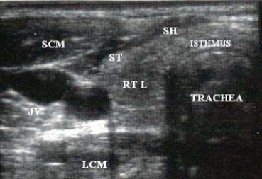 Using the image below, describe the anatomic relationship of the common carotid artery to adjacent structures.   