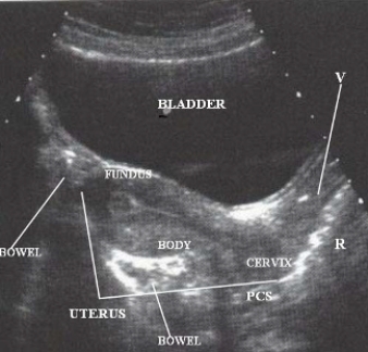 Using the image below, describe the anatomic relationship of the body of the uterus to adjacent structures.   