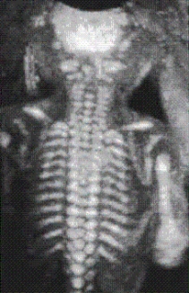 The mode used for this image is the __________. This mode is best used for showing bony anatomy.   