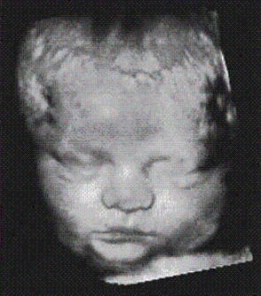 The rendering mode used for this fetal image is the __________?   