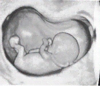 Was this image obtained transabdominally? Why or why not?   