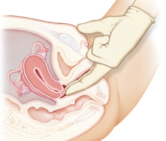 The healthcare provider is performing an assessment on a pregnant client. The examiner notes a softening in the area being assessed. Which probable sign of pregnancy is being assessed?   A)  Goodell sign. B)  Hegar sign. C)  Chadwick sign. D)  Ladin sign.