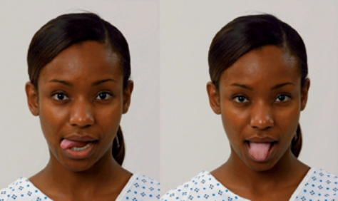 Based on the client's images, which cranial nerve is being assessed by the demonstrated activity?   A)  Trigeminal nerve (cranial nerve V) . B)  Facial nerve (cranial nerve VII) . C)  Vagus nerve (cranial nerve X) . D)  Hypoglossal nerve (cranial nerve XII) .