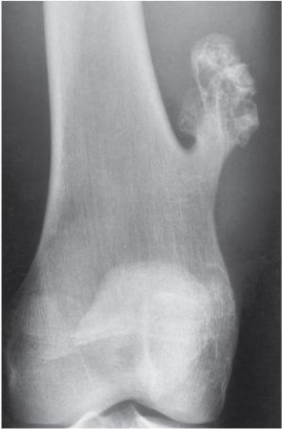 Refer to the image below.Notice the tumor grows parallel to the bone and points away from the adjacent joint.Which common benign bone tumor is demonstrated with this image?   A)  Osteochondroma. B)  Osteoid osteoma. C)  Osteoclastoma. D)  Osteogenic sarcoma.