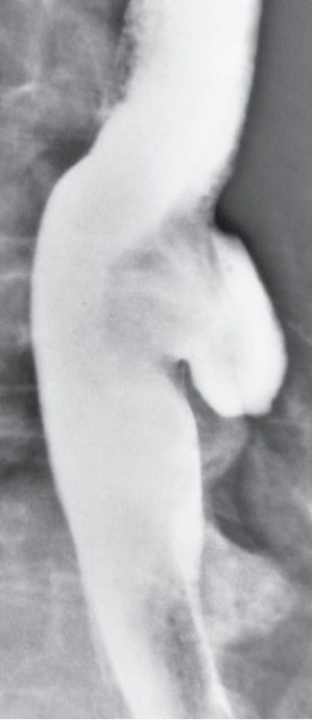 Refer to the image.What esophageal pathologic condition is demonstrated?   From Eisenberg RL: Gastrointestinal radiology: a pattern approach,Philadelphia,1990,Lippincott. A)  Varices. B)  Hiatal hernia. C)  Barrett's esophagus. D)  Esophageal diverticulum.
