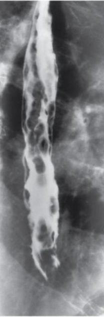 Refer to the image.This esophageal pathologic condition is described as resembling beads on a rosary.What pathologic condition is evident in this image?   A)  Varices. B)  Hiatal hernia. C)  Esophageal diverticula. D)  Gastric ulcer.