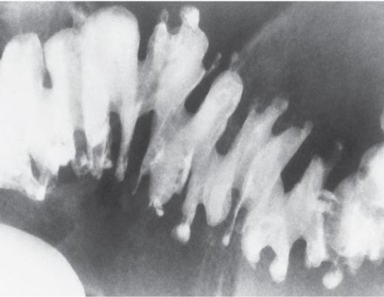 Refer to the image below.This typical saw-tooth configuration demonstrated on a barium enema exam is evidence of   A)  ulcerative colitis B)  diverticulosis C)  appendicitis D)  intussusception