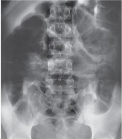 Refer to the image.This disorder is caused by a loss of bowel motility.What disorder is demonstrated in this abdominal radiograph?   A)  Mechanical obstruction. B)  Adynamic ileus. C)  Volvulus. D)  Intussusception.