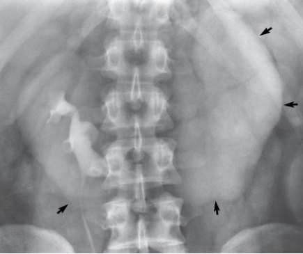 Refer to the image below.What developmental anomaly is demonstrated?   A)  Crossed ectopia. B)  Horseshoe kidney. C)  Unilateral renal agenesis. D)  Supernumerary kidney.
