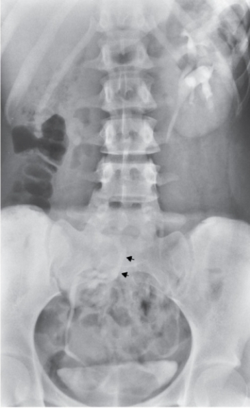 Refer to the image.Note the arrows.What condition is indicated by the arrows in this image of an intravenous urogram?   A)  Ureterocele. B)  Kidney agenesis. C)  Ectopic kidney. D)  Hypertrophic kidney.