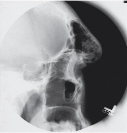 <strong>Which disease is evidenced in the radiograph below? </strong> A) Goiter. B) Gigantism. C) Acromegaly. D) Hypopituitarism.
