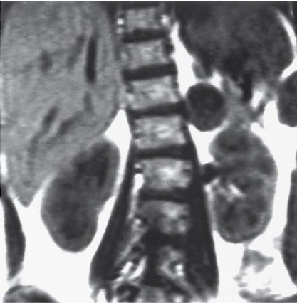 Which imaging modality provided this image of an endocrine system disorder?   A)  MRI. B)  CT. C)  Radiography. D)  US.