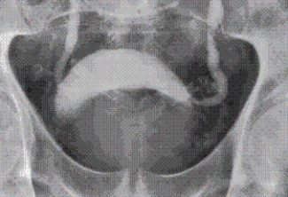 Refer to the image below obtained during an excretory urogram on a male patient.What condition is indicated in this image?   A)  Testicular torsion. B)  Benign prostatic hyperplasia. C)  Epididymitis. D)  Testicular tumor.