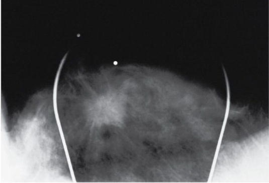 Refer to the image below.This magnified compression spot of a mammogram demonstrates the characteristic appearance of a   A)  simple cyst B)  calcific adenoma C)  fibrocystic lesion D)  breast malignancy