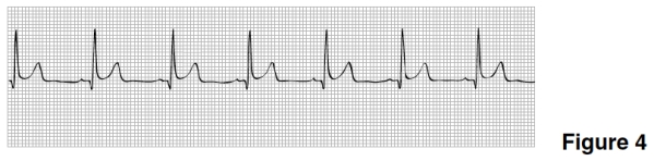 PR interval in Figure 4 is closest to   A) 0.12 seconds. B) 0.28 seconds. C) 0.04 seconds. D) 0.40 seconds.