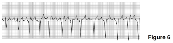 <strong>In Figure 6,the rhythm is </strong> A)Sinus rhythm. B)Atrial fibrillation. C)Atrial flutter. D)SVT.